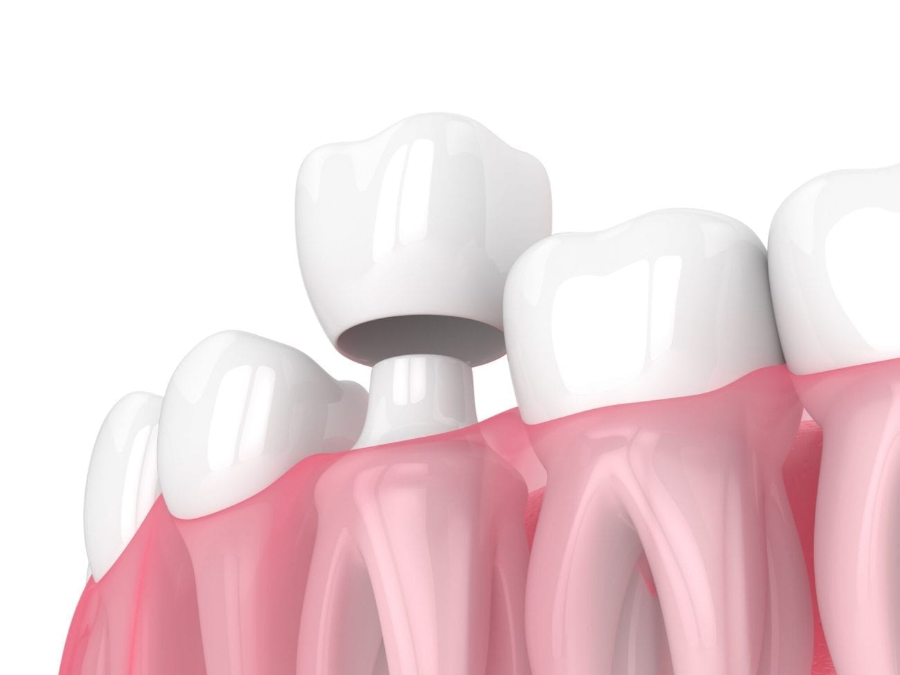 dental crowns in Alpharetta and Roswell GA