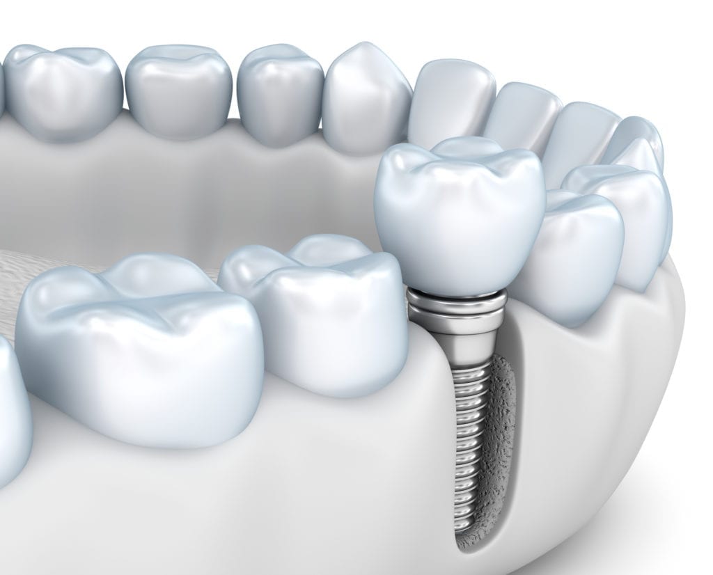 Affordable dental implants in Alpharetta Georgia