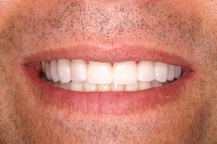 after cosmetic dentistry in Alpharetta, GA