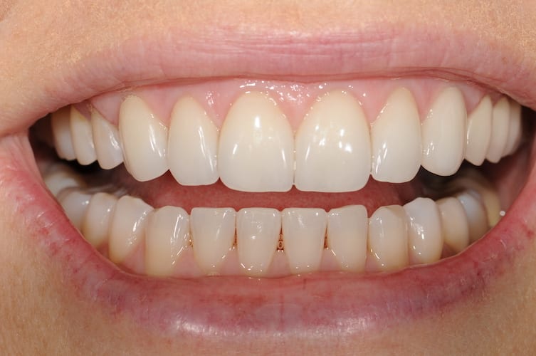 after cosmetic dentistry in Alpharetta, GA