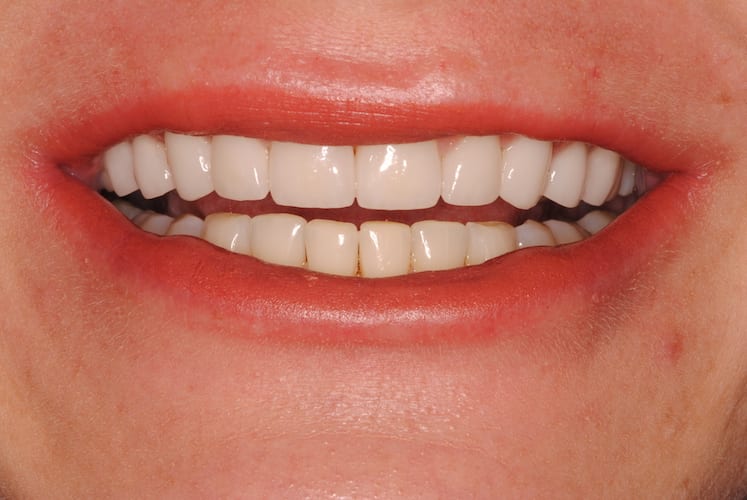 after cosmetic dentistry in Alpharetta, GA