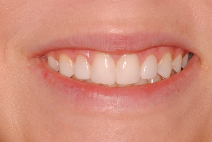 after cosmetic dentistry in Alpharetta, GA