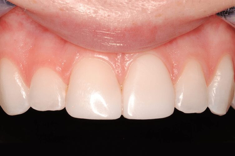 after cosmetic dentistry in Alpharetta, GA