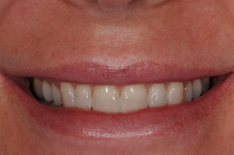 before cosmetic dentistry in Alpharetta, GA