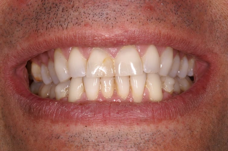 before cosmetic dentistry in Alpharetta, GA