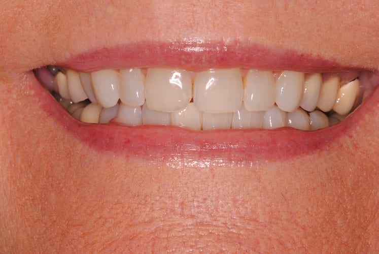 before cosmetic dentistry in Alpharetta, GA