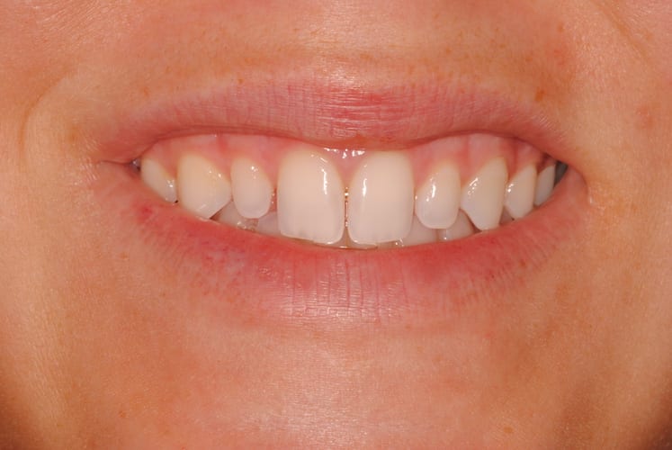 before cosmetic dentistry in Alpharetta, GA