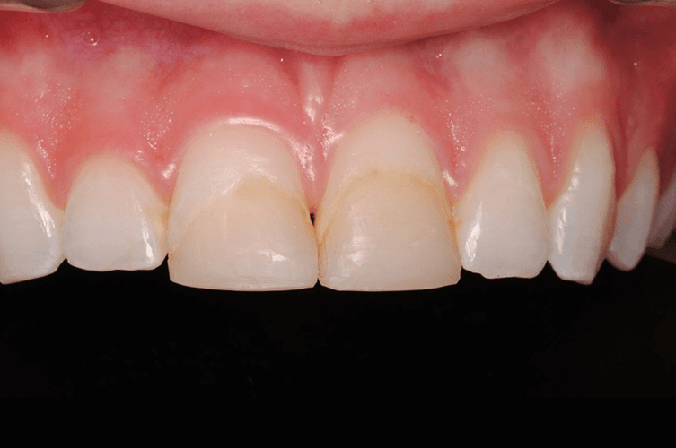 before cosmetic dentistry in Alpharetta, GA