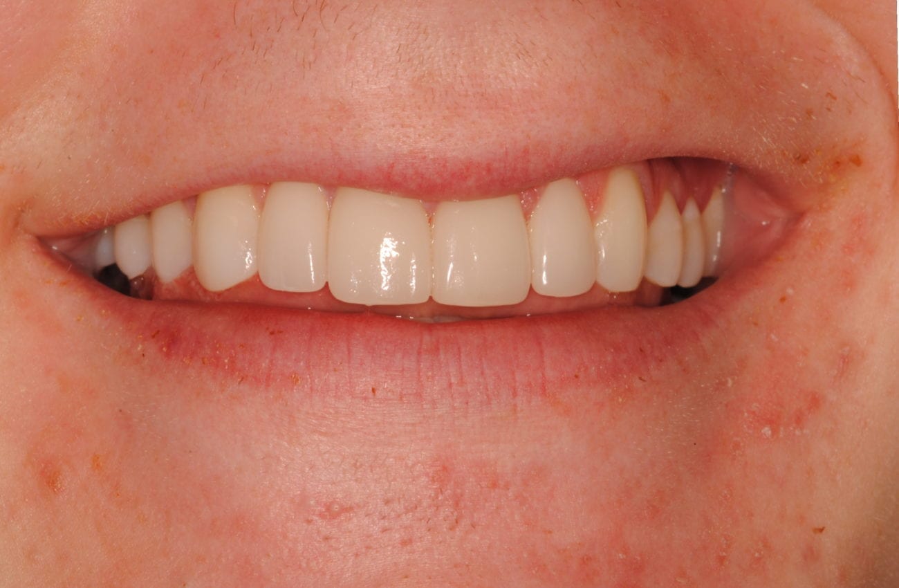 after cosmetic dentistry in Alpharetta, GA