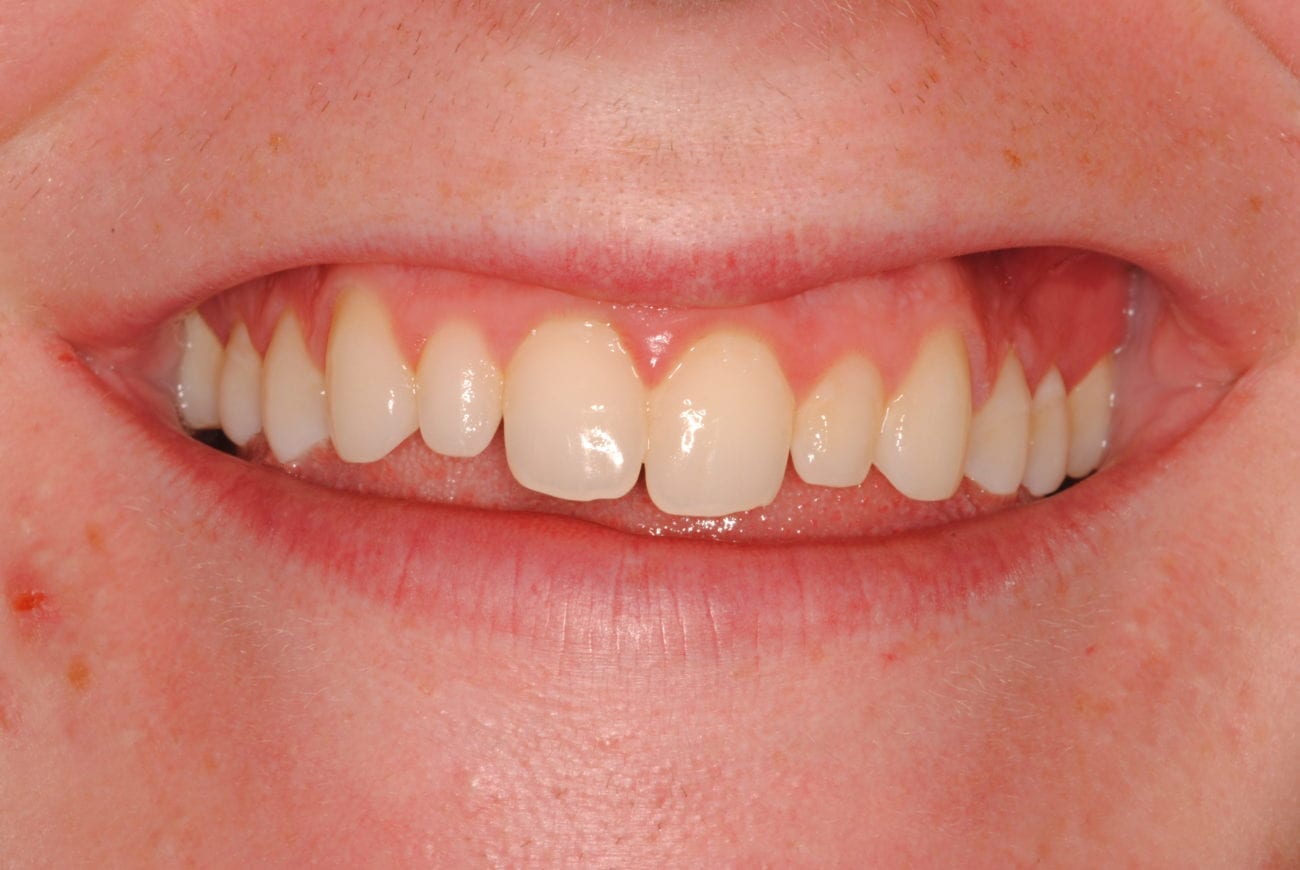 before cosmetic dentistry in Alpharetta, GA