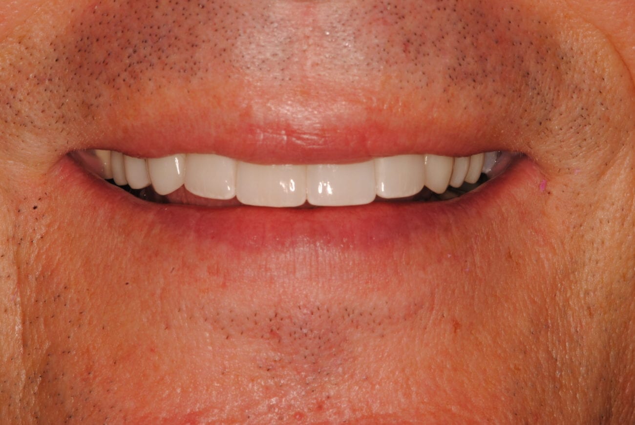 after cosmetic dentistry in Alpharetta, GA