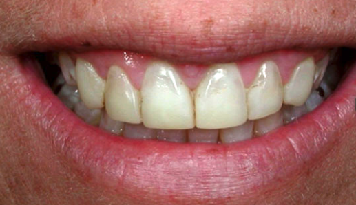 before cosmetic dentistry in Alpharetta, GA