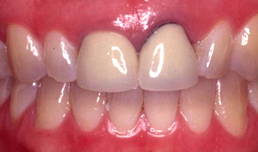 before cosmetic dentistry in Alpharetta, GA