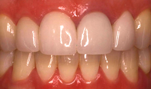 after cosmetic dentistry in Alpharetta, GA