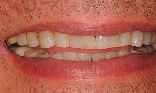 before cosmetic dentistry in Alpharetta, GA