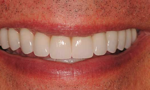 after cosmetic dentistry in Alpharetta, GA