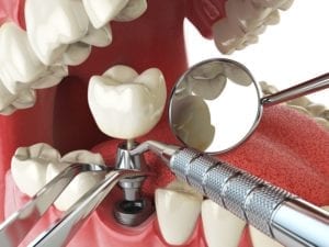 alpharetta, ga dental implants