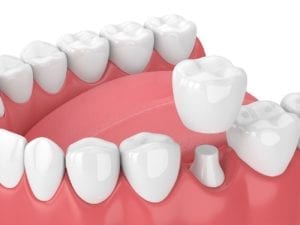 affordable dental crowns in alpharetta, georgia