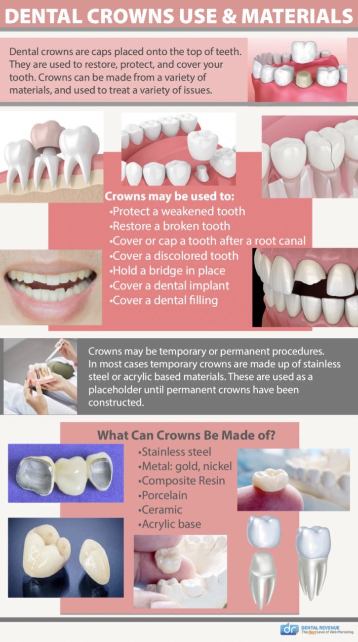 Dental crown materials Infographic