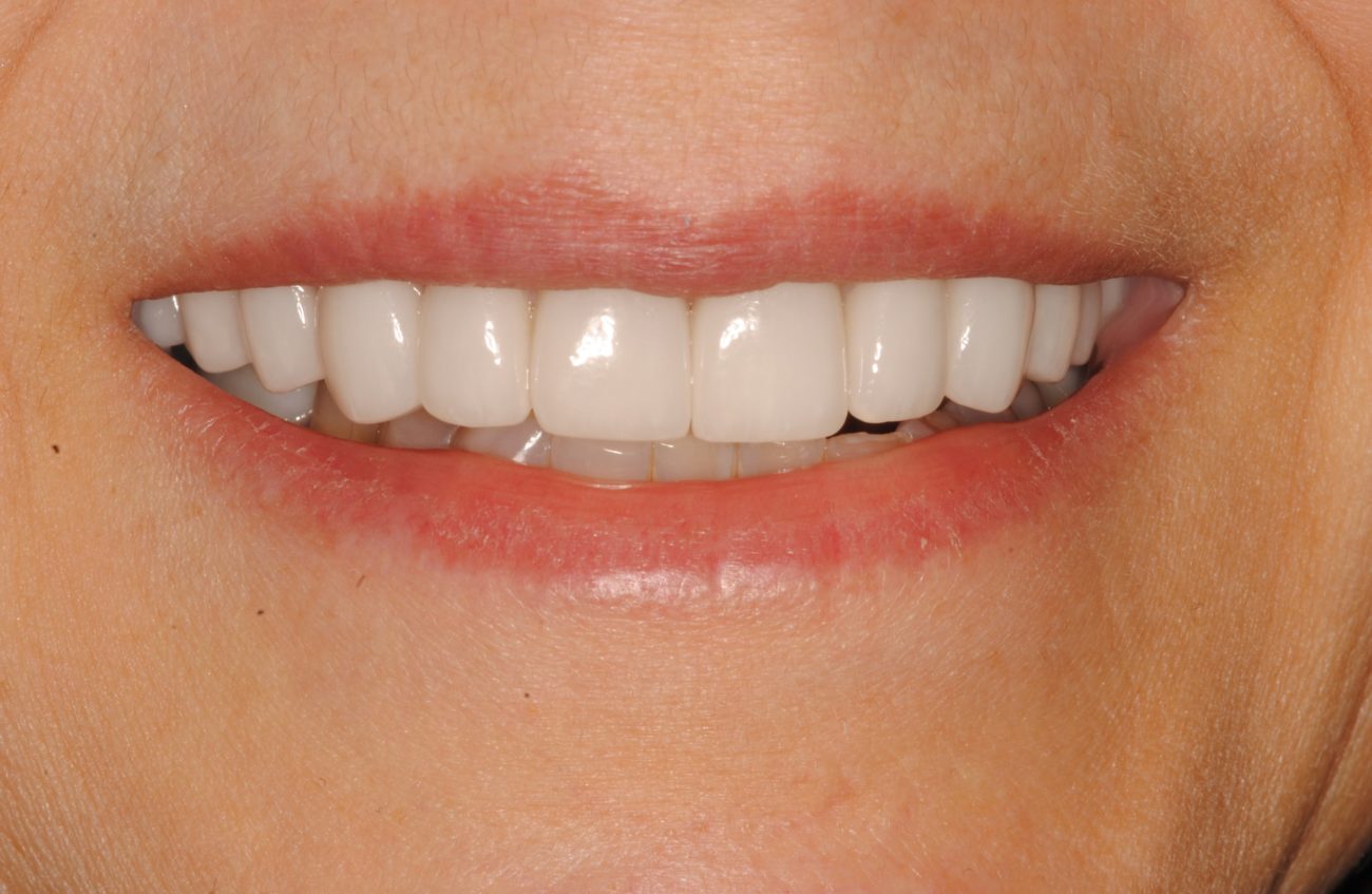 after cosmetic dentistry in Alpharetta, GA