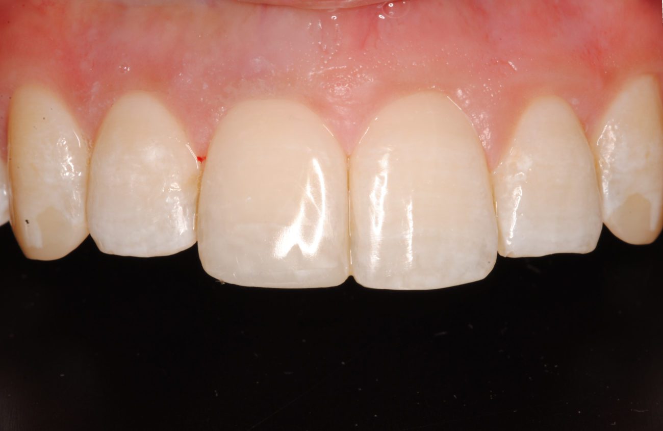 after cosmetic dentistry in Alpharetta, GA