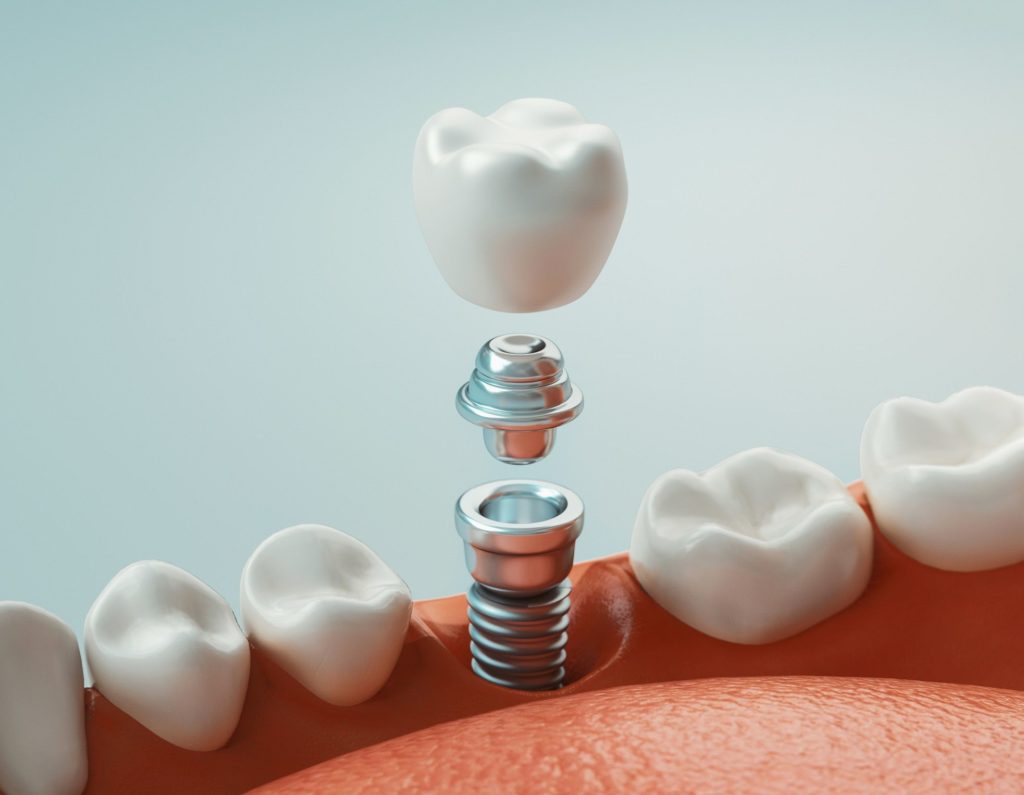 3D model of dental implant dentist Alpharetta Georgia