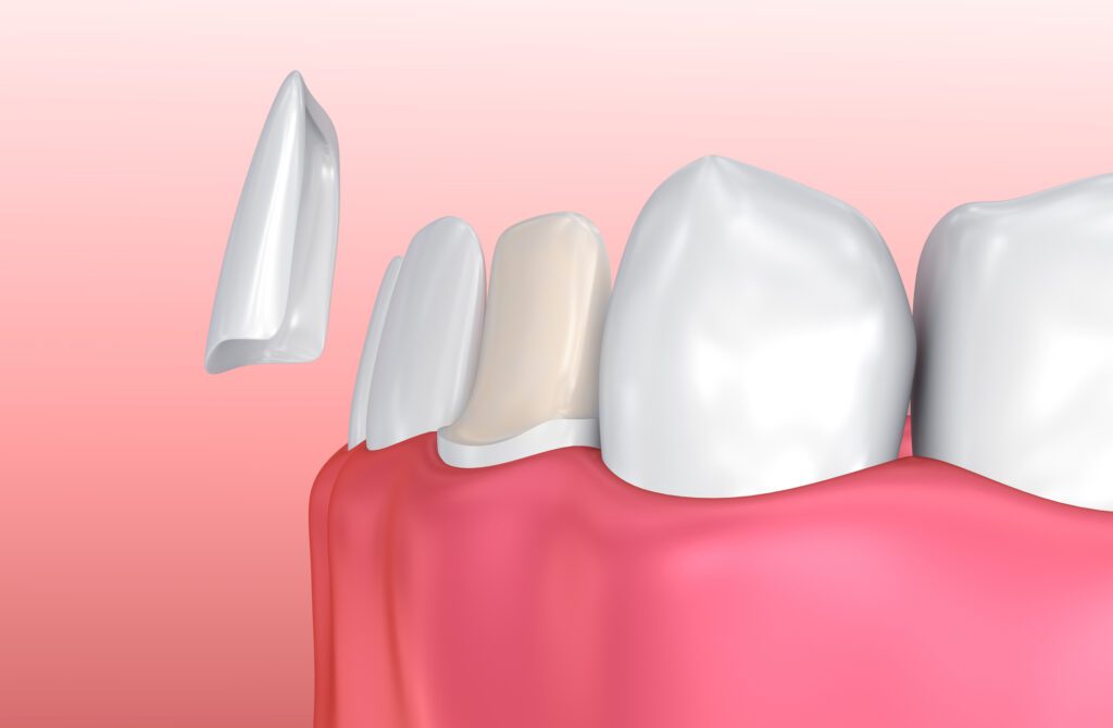 PORCELAIN VENEERS in ALPHARETTA GA can help solve a variety of imperfections in your smile