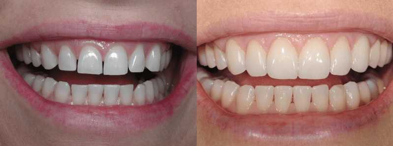 Dental patient before and after Invisalign