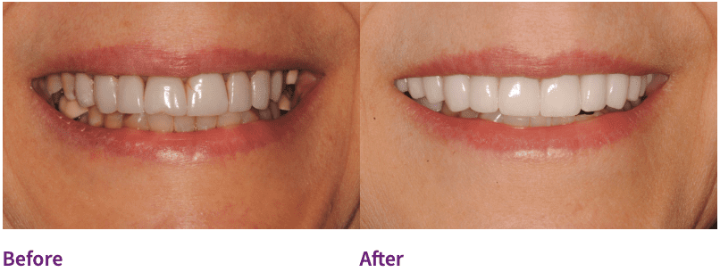 Dental patient before and after replacing old dental crowns