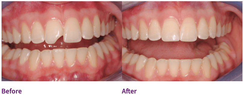 dental patient before and after dental bonding