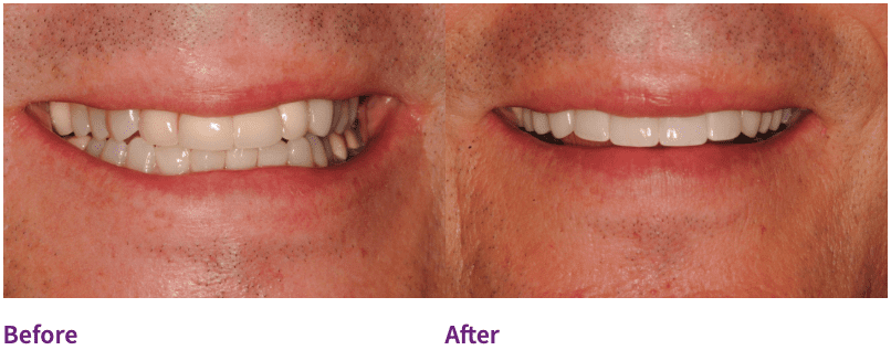 Dental patient before and after dental implants