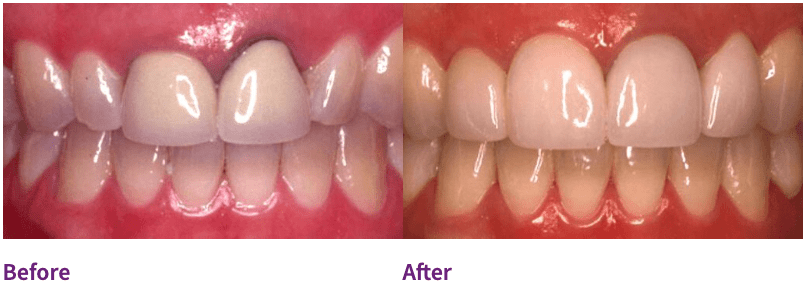 Dental patient before and after porcelain veneers