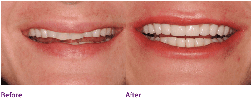 dental patient before and after porcelain veneers on front teeth