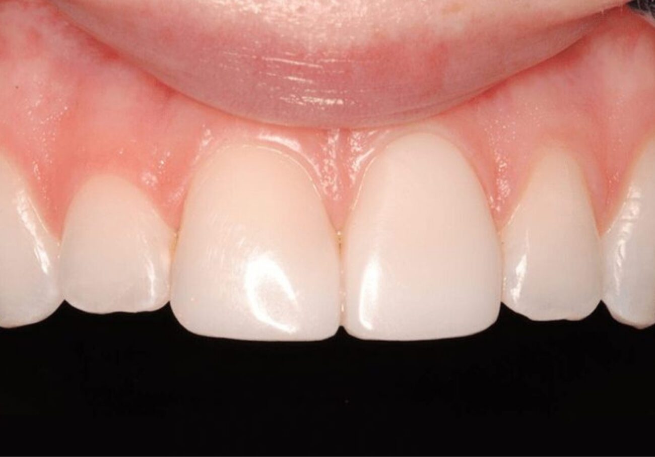 after cosmetic dentistry in Alpharetta, GA