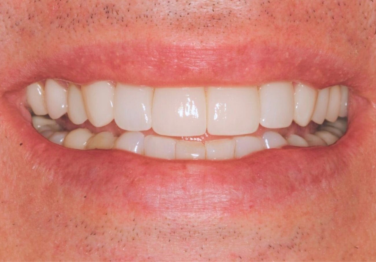 after cosmetic dentistry in Alpharetta, GA