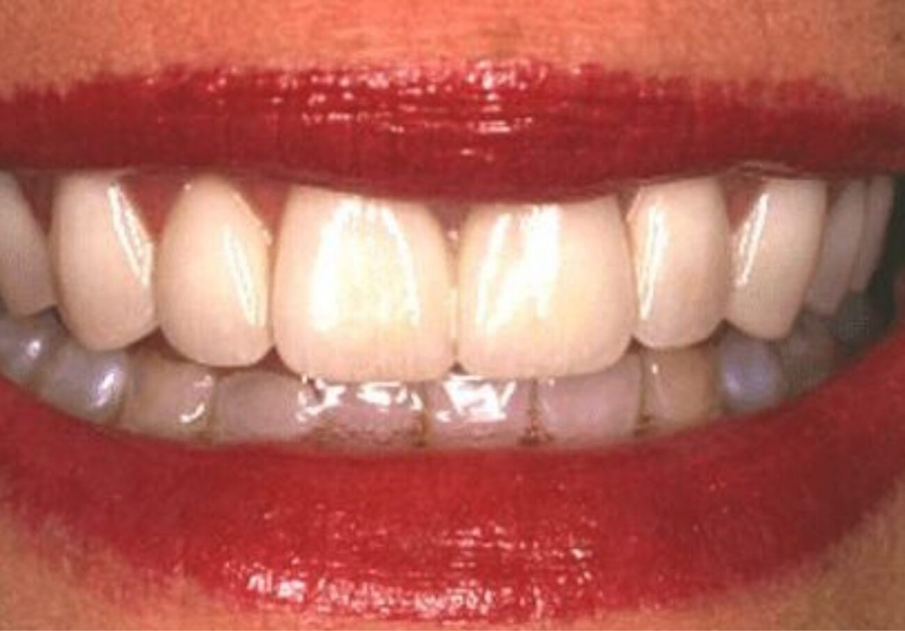 after cosmetic dentistry in Alpharetta, GA