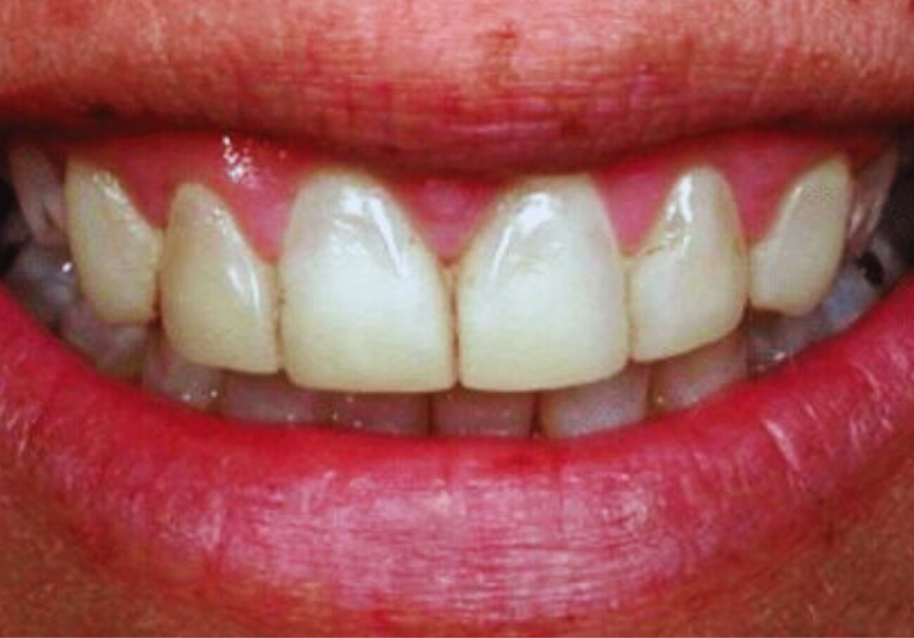 before cosmetic dentistry in Alpharetta, GA