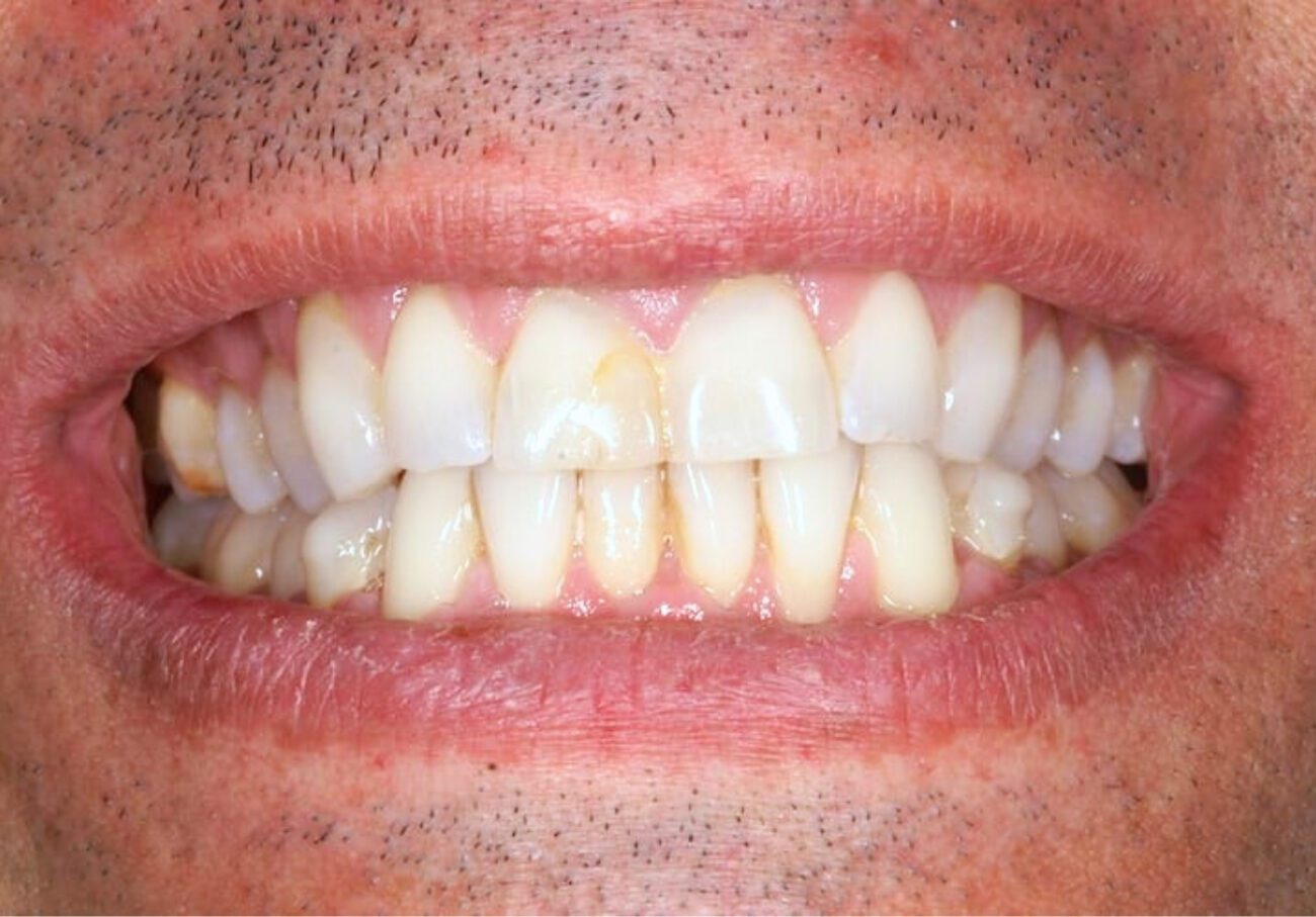 before cosmetic dentistry in Alpharetta, GA