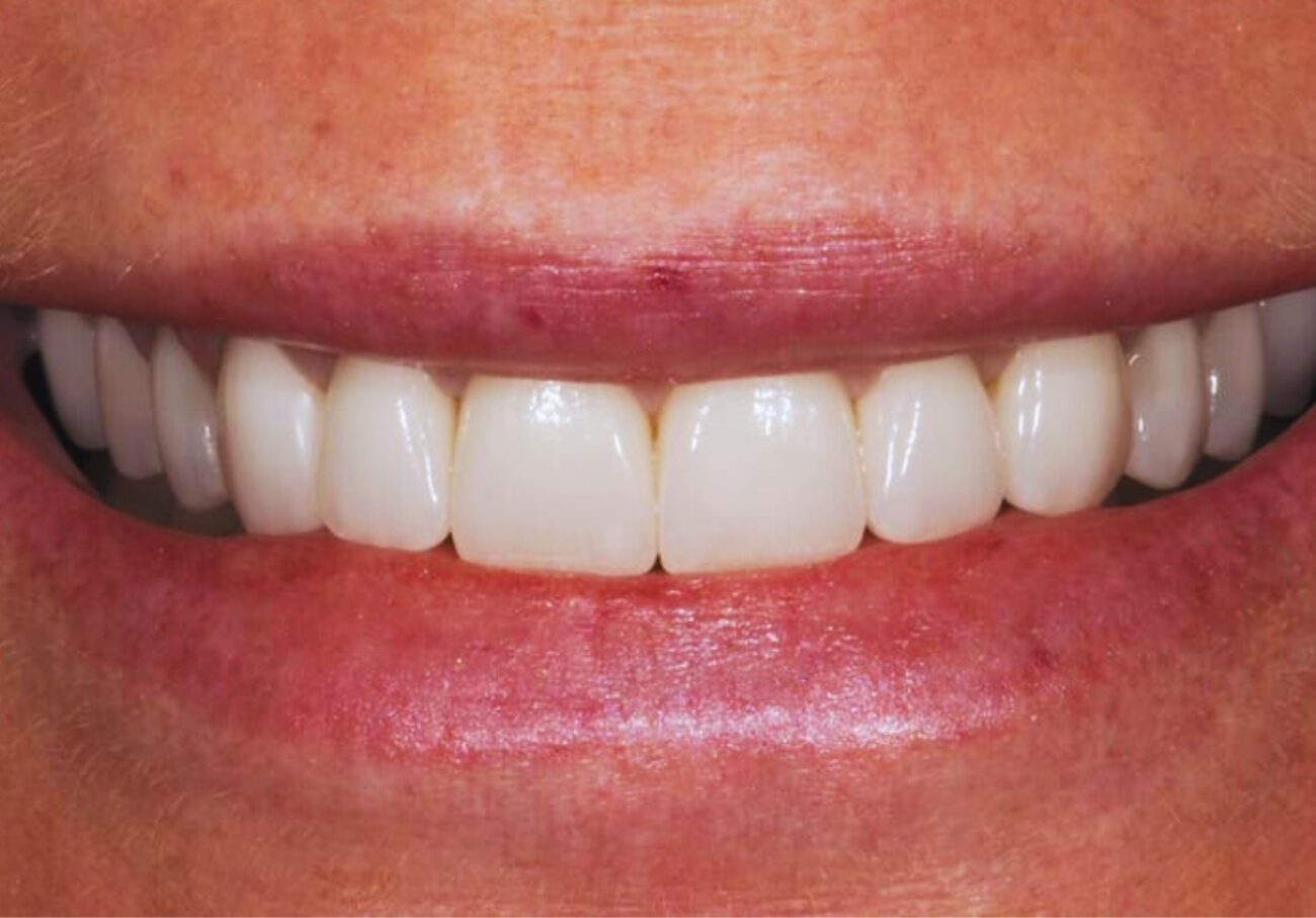 after cosmetic dentistry in Alpharetta, GA