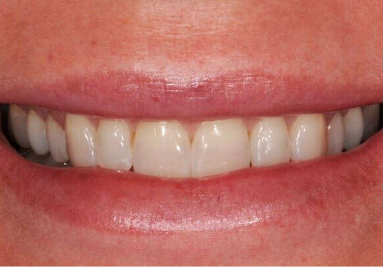 before cosmetic dentistry in Alpharetta, GA