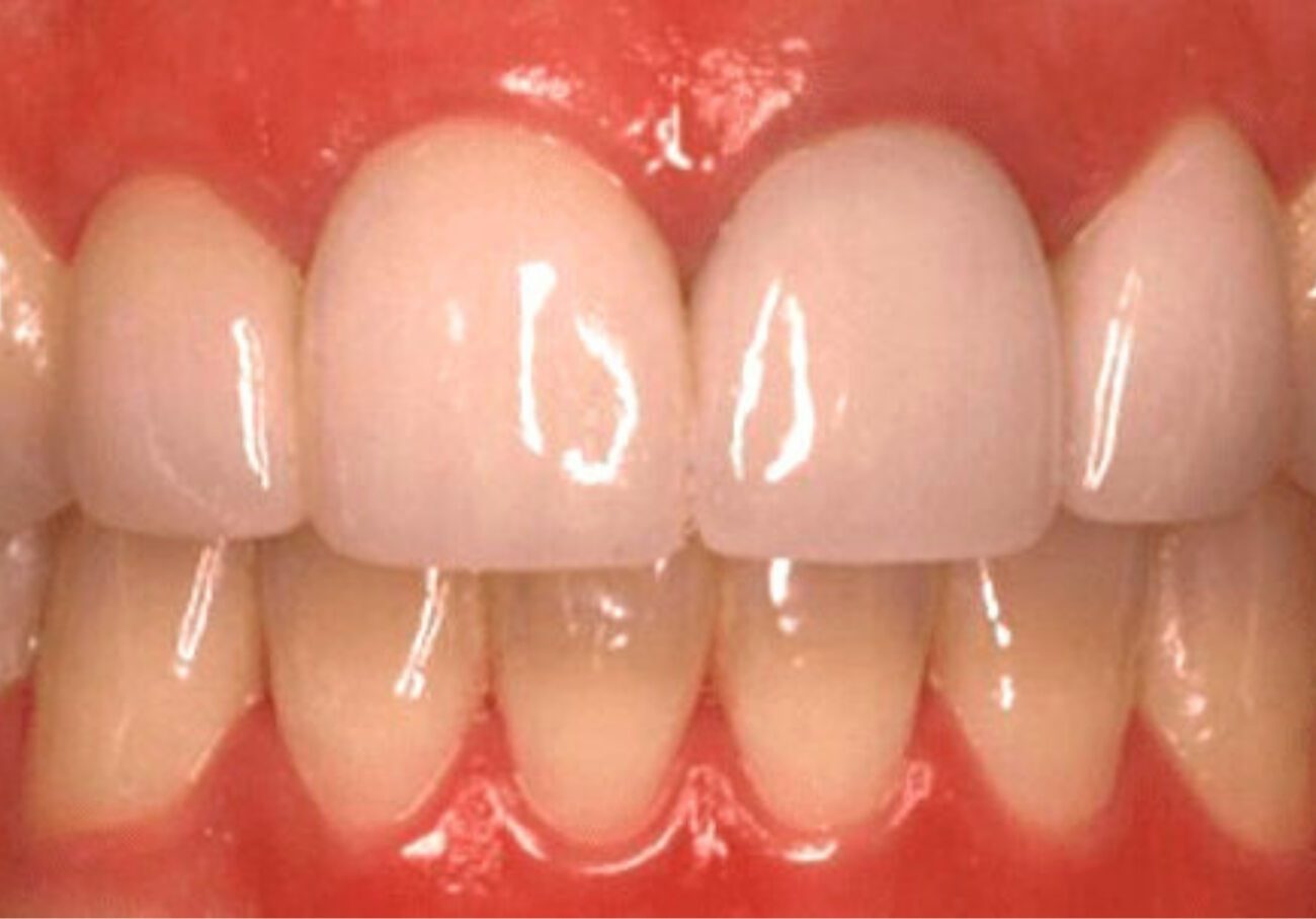 after cosmetic dentistry in Alpharetta, GA