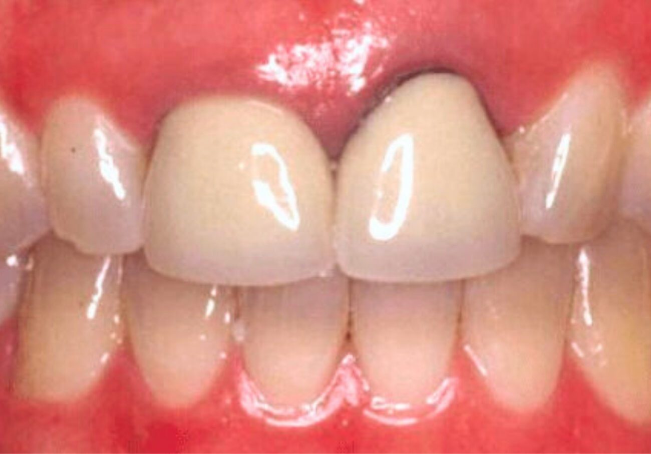 before cosmetic dentistry in Alpharetta, GA