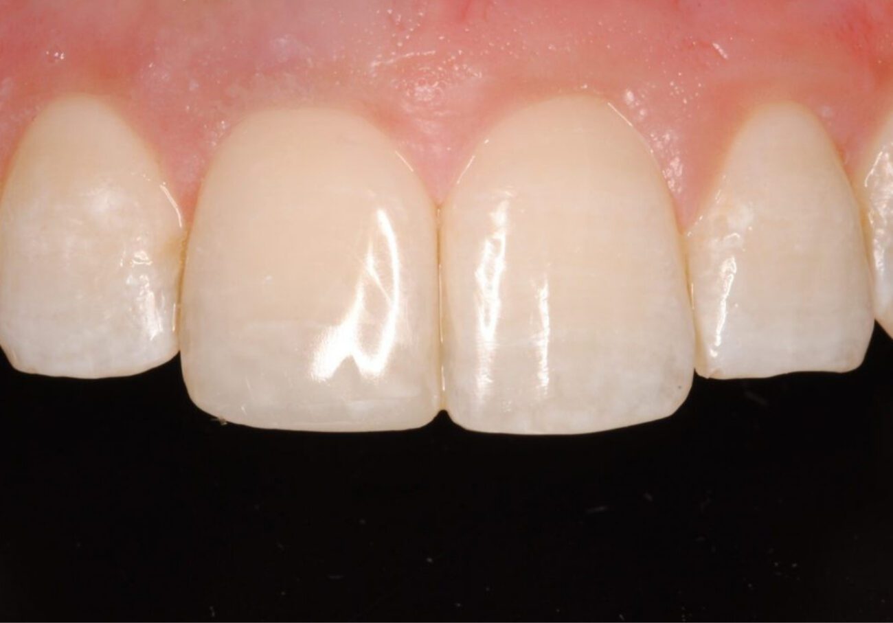 after cosmetic dentistry in Alpharetta, GA