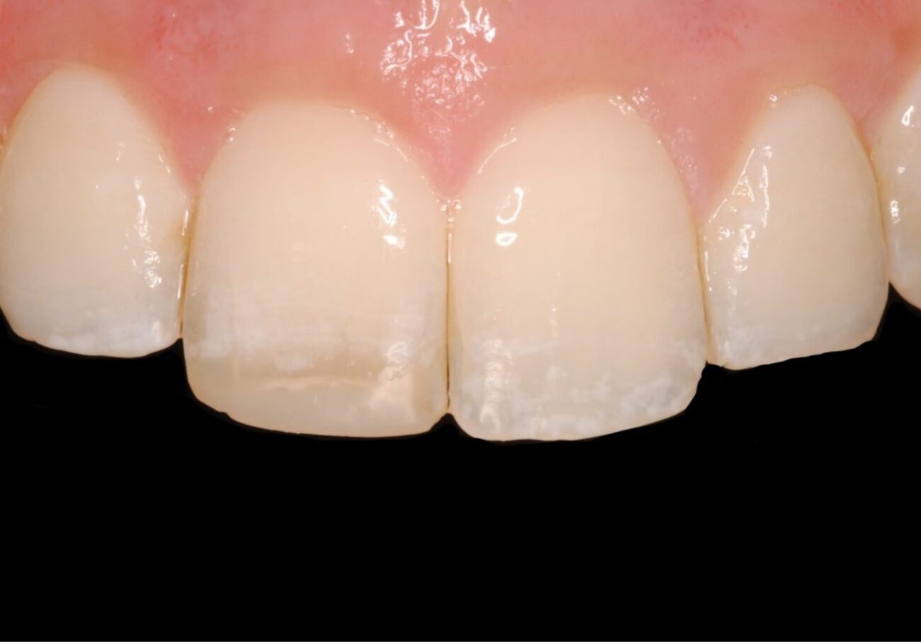 before cosmetic dentistry in Alpharetta, GA