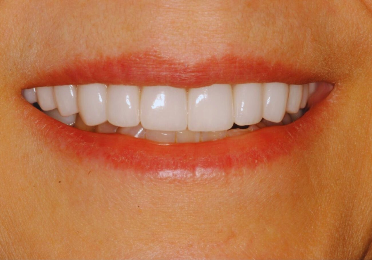 after cosmetic dentistry in Alpharetta, GA