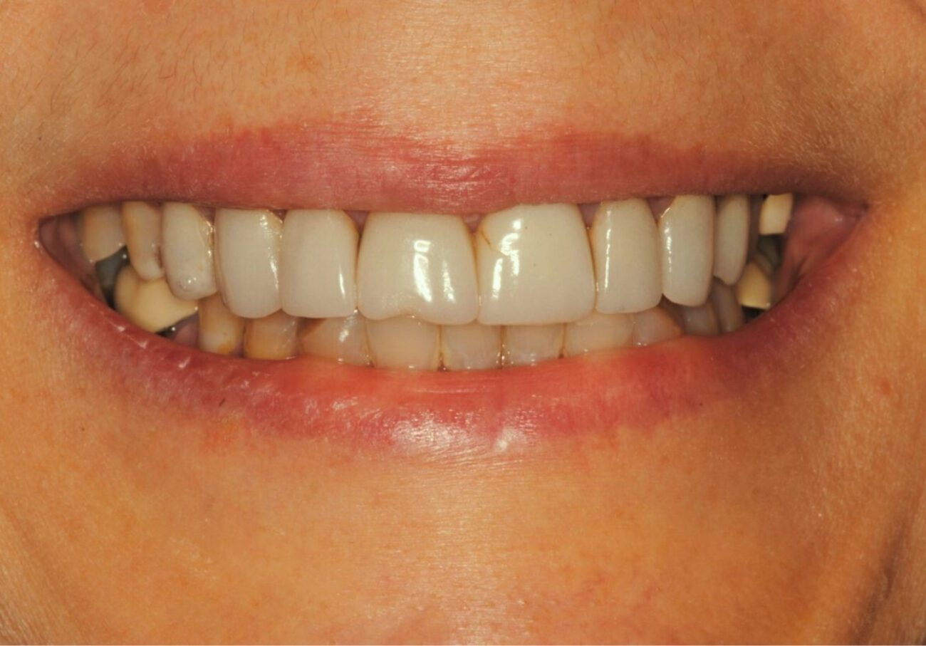 before cosmetic dentistry in Alpharetta, GA