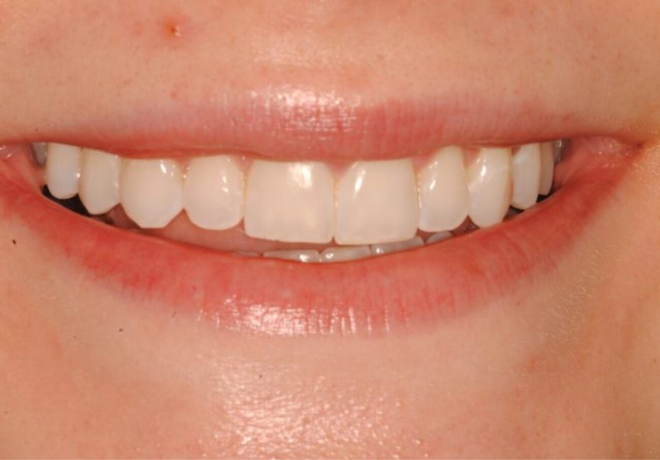 after cosmetic dentistry in Alpharetta, GA
