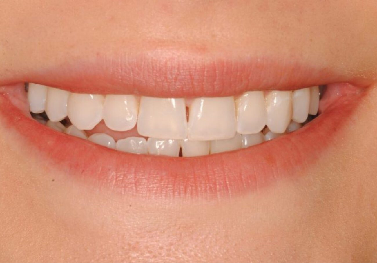 before cosmetic dentistry in Alpharetta, GA