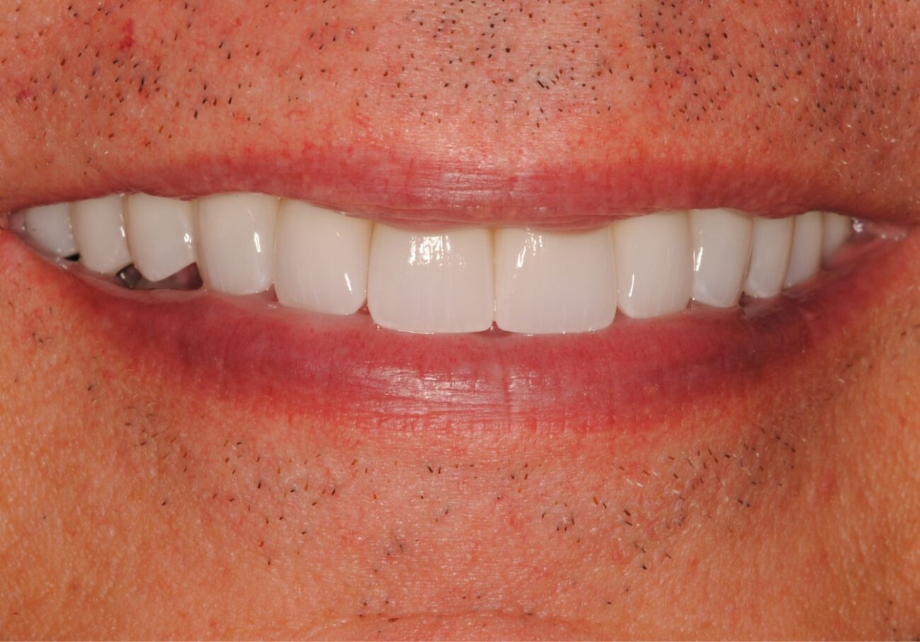after cosmetic dentistry in Alpharetta, GA