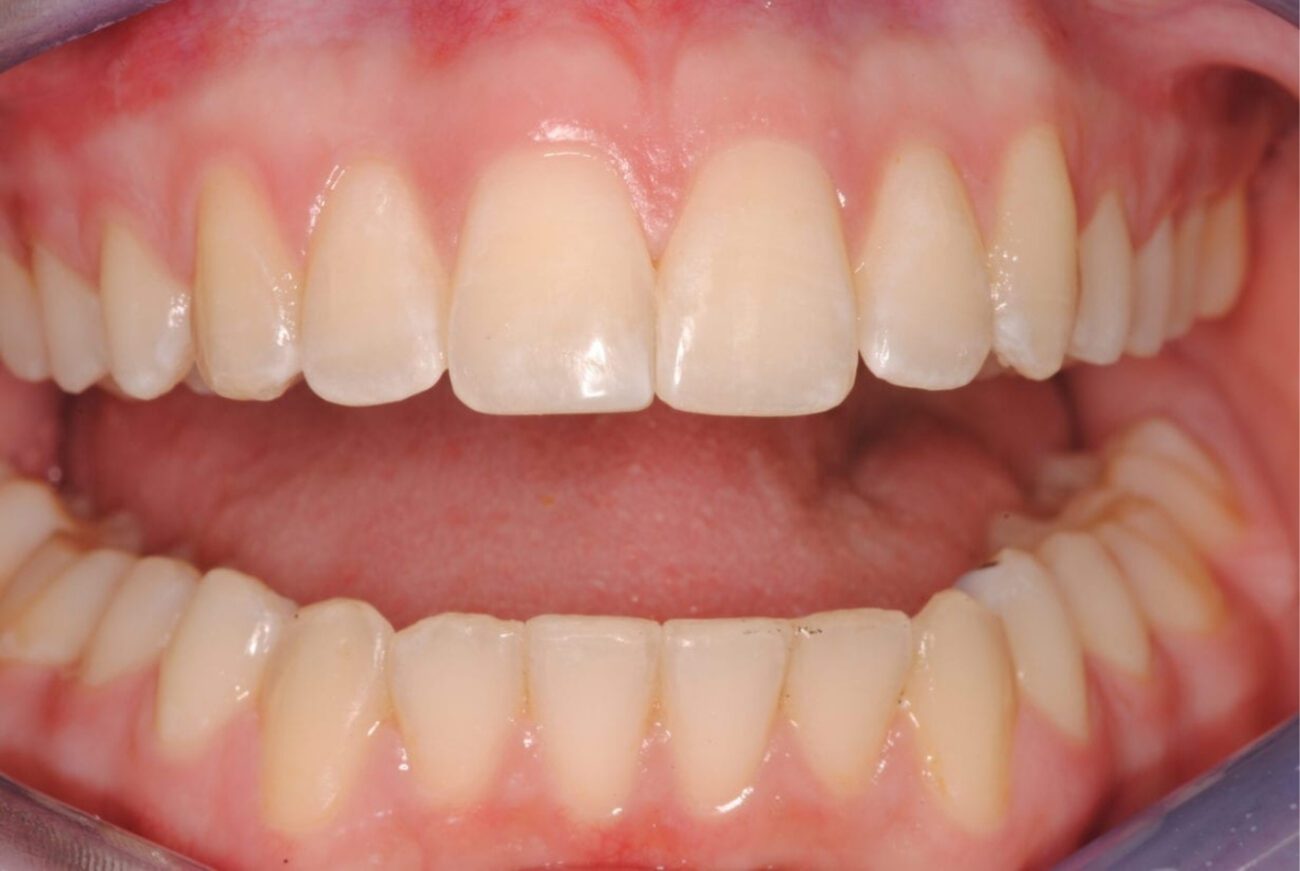 after cosmetic dentistry in Alpharetta, GA